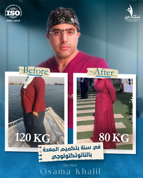 شكل الجسم بعد تكميم المعدة